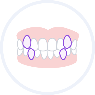 八重歯（上下）